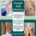 Nail Fungus - Symptoms, Causes and Treatments