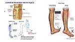 Nerve Injuries to the Foot
