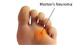 Neuromas in the Feet | Weil Foot & Ankle Institute