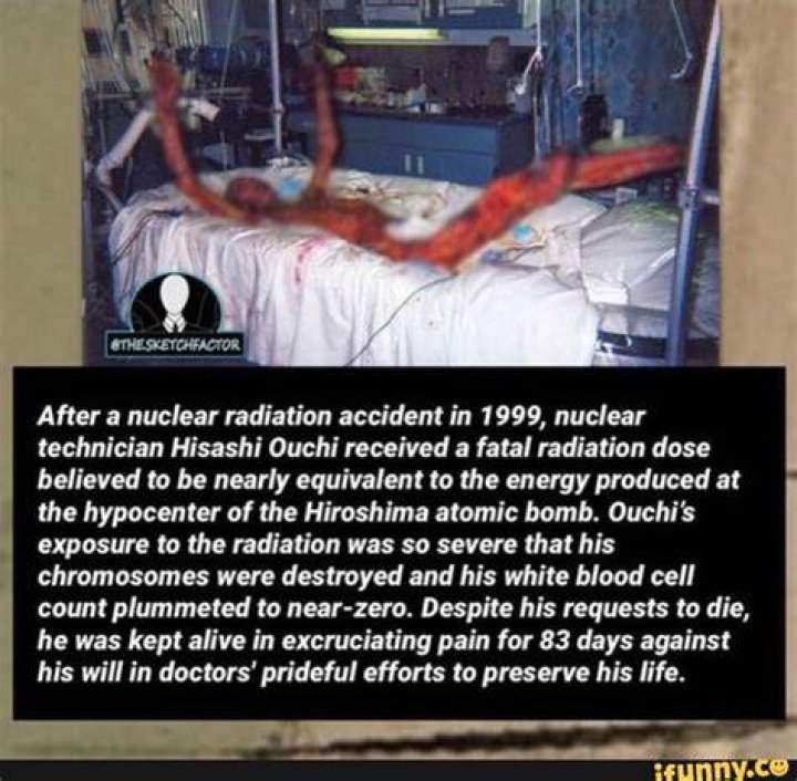 Pictures of Hisashi Ouchi: The Untold Story of Radiation Exposure and Its Impact