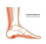 Plantar Fasciitis | Foot and Ankle Specialists