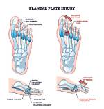 Plantar Plate Tears and How to Treat Them