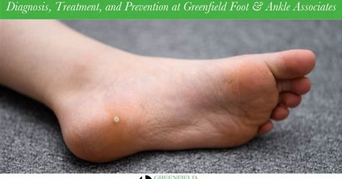 Plantar Wart (Verruca Plantaris) | Artisan Foot and Ankle Specialists