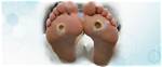 Pressure Ulcers | Foot and Ankle Specialists