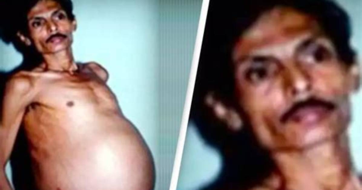 Sanju Bhagat’s Twin Lived Inside Him for 36 Year's