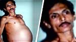 Sanju Bhagat’s Twin Lived Inside Him for 36 Year's