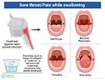 Sore Throat After Being in the Sun