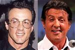Stallone Chirurgie - Bonjour Buzz