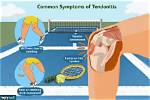 Tendonitis – Causes, Symptoms and Treatment