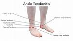 Tendonitis | Foot and Ankle Specialists