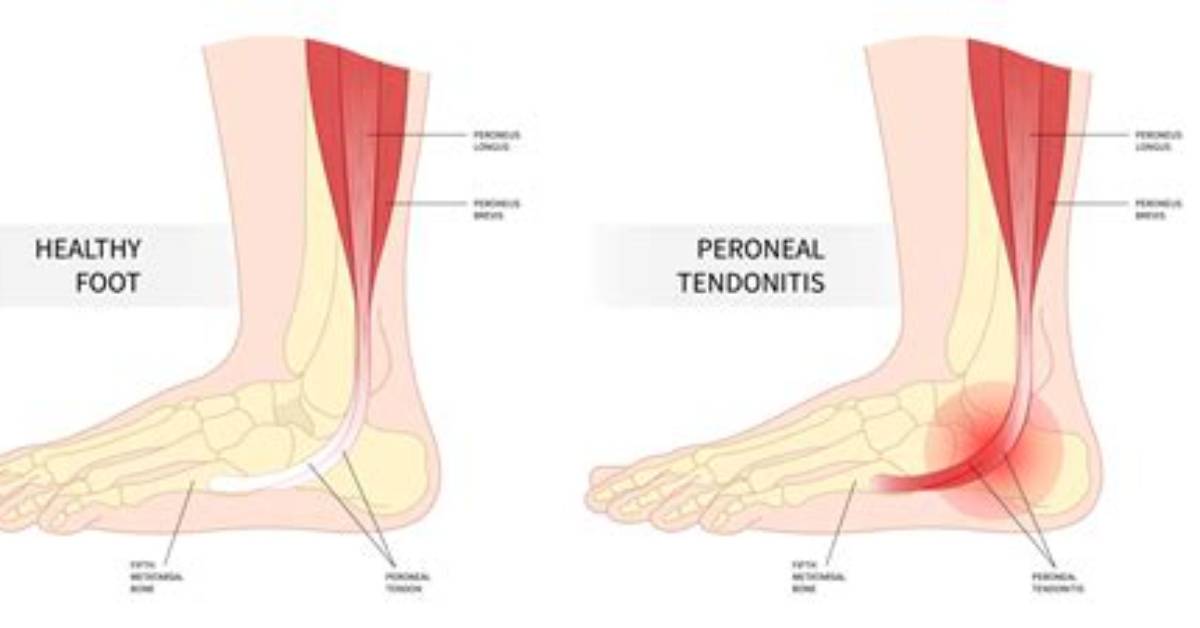 Tendonitis of the Foot – Types, Causes, Symptoms and Treatment