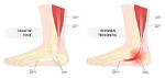 Tendonitis of the Foot – Types, Causes, Symptoms and Treatment