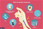 Tendonitis
