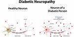 The Effects Diabetic Neuropathy Can Have on Your Feet