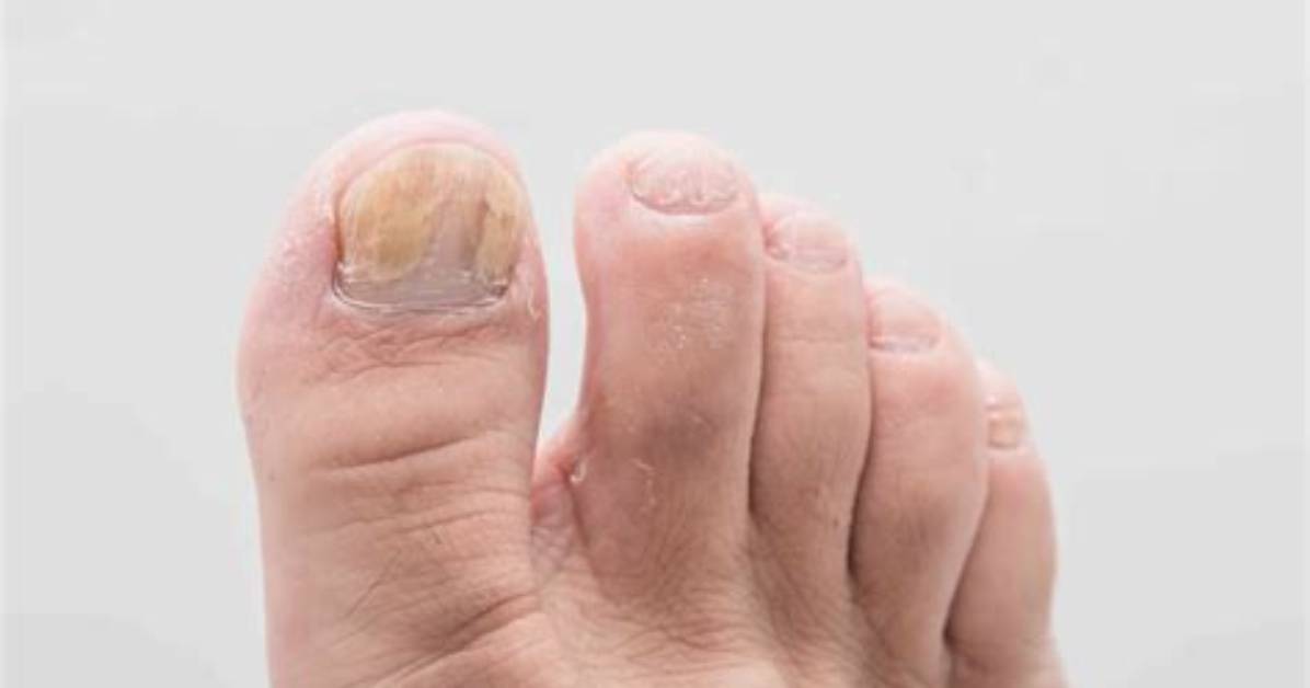 Toenail Problems