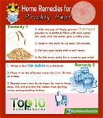 Top 10 Home Remedies for Prickly Heat