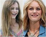 Vanessa Paradis Chirurgie