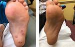 Wart Removal | Suffolk, Hampton, Va