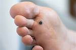 Warts Treatment in Santa Cruz and Watsonville, Ca | Santa Cruz Podiatrist