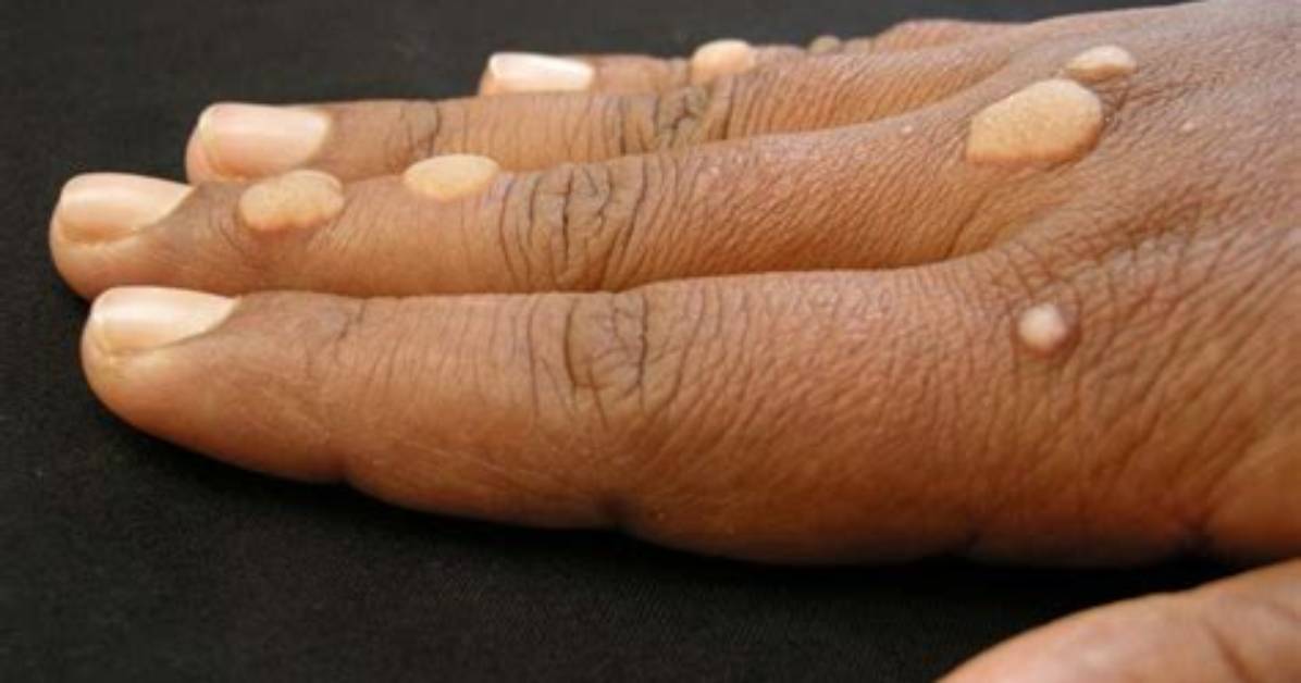 Warts
