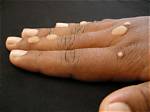 Warts