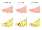 What Is Mallet Toe – Causes, Symptoms and Treatment