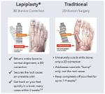 What Is the Lapiplasty Procedure?
