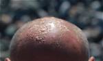 Why a Sunburnt Bald Head Is the Worst Sunburn, According to Dermatologists