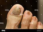 Why Are My Toenails Discolored?