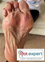 Why Is the Skin on My Feet So Dry and Flaky?