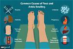 Why One Foot, Ankle, or Leg Might Be Swollen